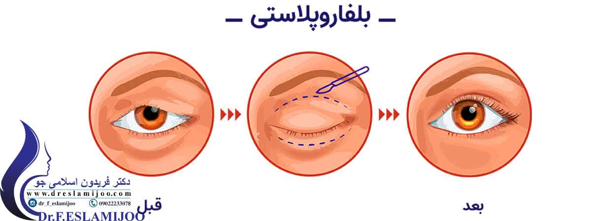 تفاوت جراحی بلفاروپلاستی یا عمل پلک با بلفاروپلاتی