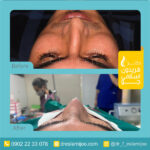 نمونه جراحی عمل بینی دکتر فریدون اسلامی جو